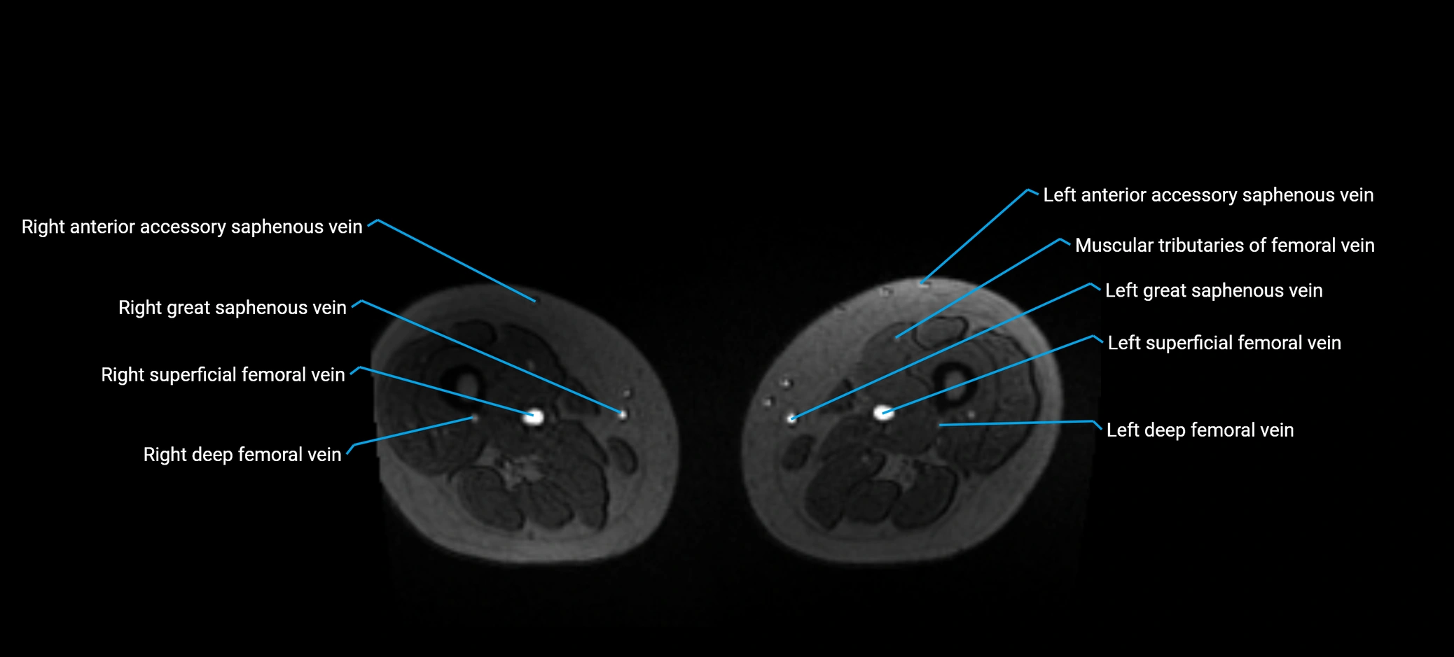 MRV abdomen pelvis & lower limb axial cross sectional anatomy labelled MRI image 291 (1).webp
